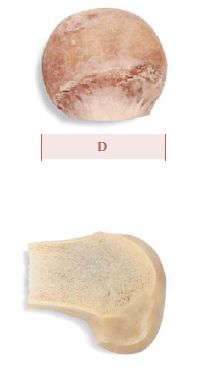 Femoral Heads Femoral Heads